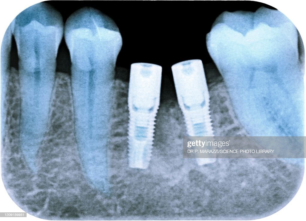 dental implants following tooth extraction, x-ray - tornillo en la boca fotografías e imágenes de stock