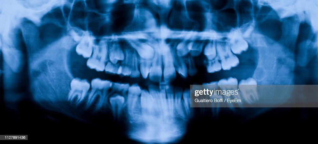 x-ray image of human teeth - diente roto fotografías e imágenes de stock