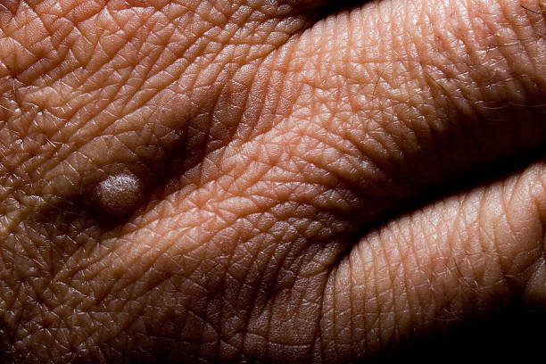 close-up of a wart on a persons hand - verrugas fotografías e imágenes de stock