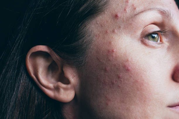 acne woman skin closeup with hormonal acne pimples - before photo - espinilla fotografías e imágenes de stock
