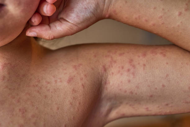 allergic reaction due to antibiotics, in human skin of a 5-year-old child - infeccion de la piel fotografías e imágenes de stock